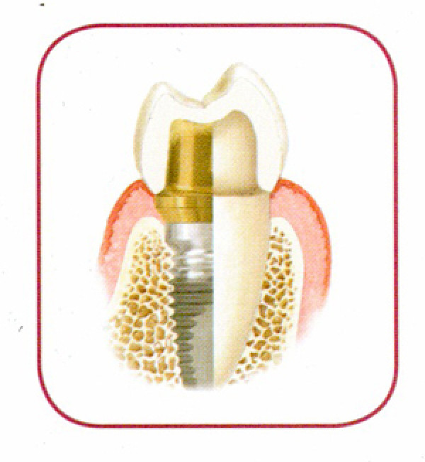 Implant dentaire à Nîmes
